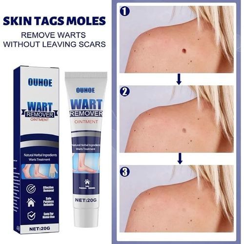 Effective Herbal Wart Removal Ointment Cream