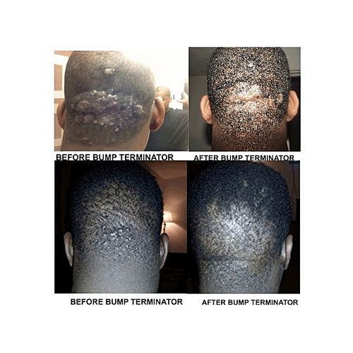 Anti-Bump Lotion - Bump Terminator - 120ml - 6 Bottle